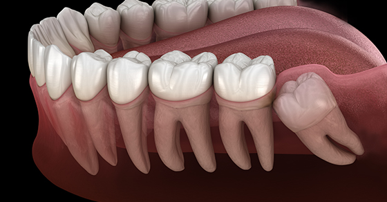 Is wisdom teeth removal really always necessary?