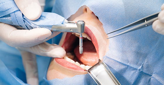 How to Prepare for Your Dental Implant Surgery