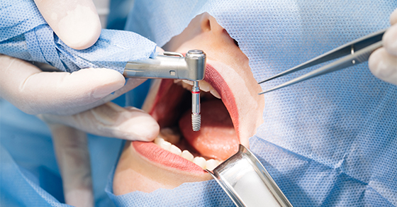 How to prepare for your dental implant surgery