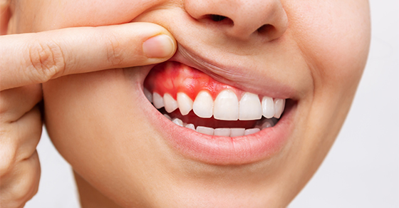 What Is Periodontitis, and How Can I Avoid It?