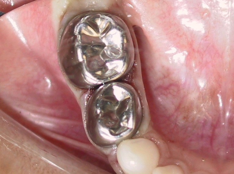 Stainless-Steel-crown