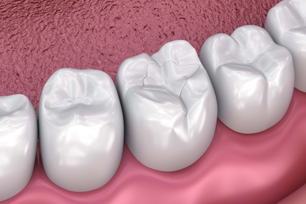 composite-fillings-2102