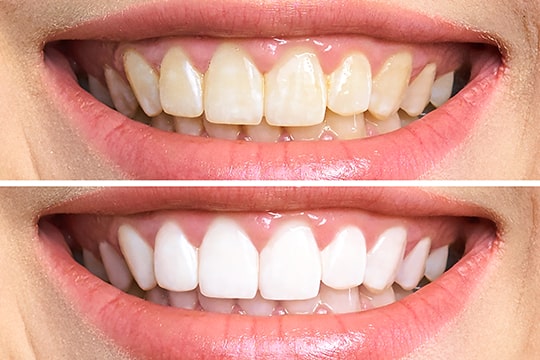 How to Achieve and Maintain a Brighter Smile: Teeth Whitening Options