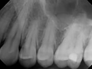 Periapical X-rays